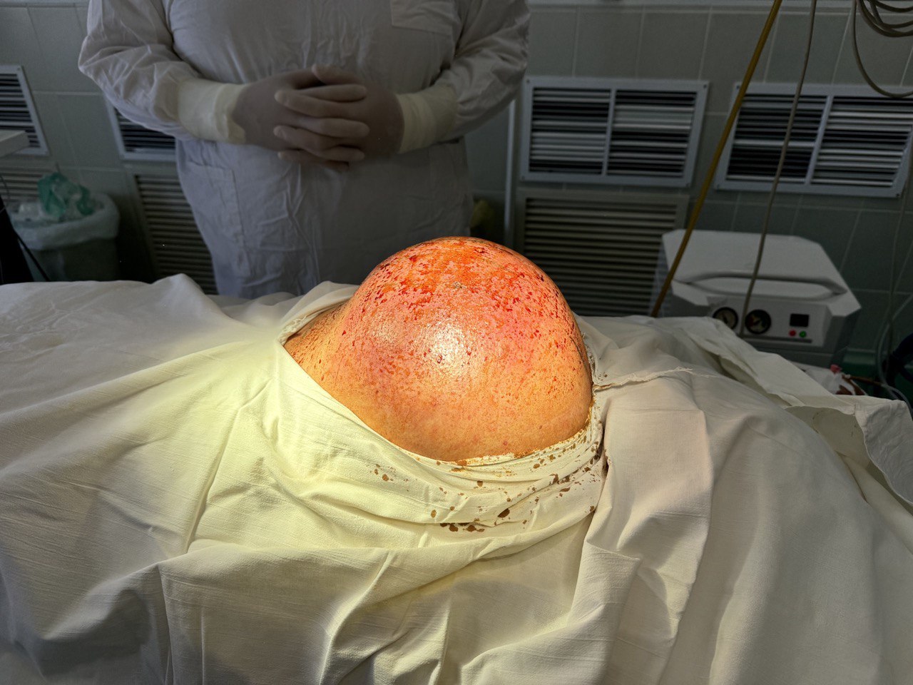 В Туле врачи удалили гигантскую опухоль
